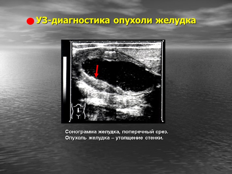 УЗ-диагностика опухоли желудка Сонограмма желудка, поперечный срез. Опухоль желудка – утолщение стенки.